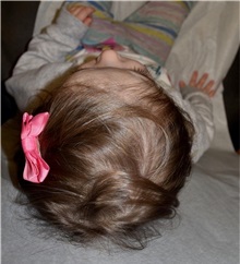 Craniosynostosis After Photo by Rachel Ruotolo, MD; Garden City, NY - Case 38094