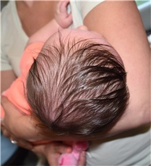 Craniosynostosis Before Photo by Rachel Ruotolo, MD; Garden City, NY - Case 38094