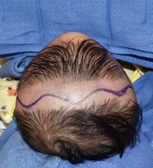 Craniosynostosis Before Photo by Rachel Ruotolo, MD; Garden City, NY - Case 38115