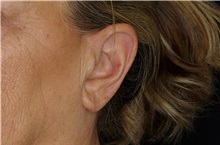 Ear Surgery After Photo by Landon Pryor, MD, FACS; Rockford, IL - Case 38162