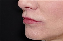 Lip Augmentation/Enhancement After Photo by Landon Pryor, MD, FACS; Rockford, IL - Case 38228