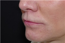 Lip Augmentation/Enhancement Before Photo by Landon Pryor, MD, FACS; Rockford, IL - Case 38228