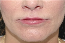 Lip Augmentation/Enhancement After Photo by Landon Pryor, MD, FACS; Rockford, IL - Case 38228