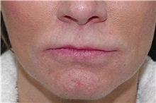 Lip Augmentation/Enhancement Before Photo by Landon Pryor, MD, FACS; Rockford, IL - Case 38228