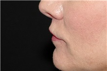 Lip Augmentation/Enhancement After Photo by Landon Pryor, MD, FACS; Rockford, IL - Case 38228