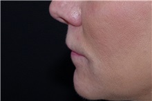 Lip Augmentation/Enhancement Before Photo by Landon Pryor, MD, FACS; Rockford, IL - Case 38228