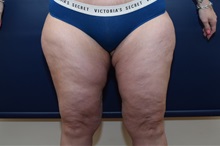 Thigh Lift After Photo by Michael Dobryansky, MD, FACS; Garden City, NY - Case 38361