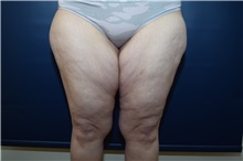 Thigh Lift Before Photo by Michael Dobryansky, MD, FACS; Garden City, NY - Case 38361