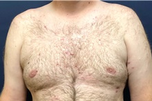 Male Breast Reduction After Photo by Michael Dobryansky, MD, FACS; Garden City, NY - Case 38367