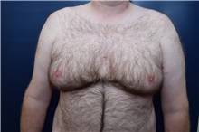 Male Breast Reduction Before Photo by Michael Dobryansky, MD, FACS; Garden City, NY - Case 38367