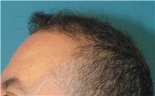 Hair Transplant After Photo by Scott Sattler, MD,  FACS; Seattle, WA - Case 38413