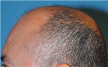 Hair Transplant Before Photo by Scott Sattler, MD,  FACS; Seattle, WA - Case 38413