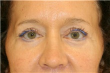 Eyelid Surgery After Photo by Steve Laverson, MD, FACS; Rancho Santa Fe, CA - Case 38426