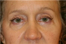 Eyelid Surgery Before Photo by Steve Laverson, MD, FACS; Rancho Santa Fe, CA - Case 38426