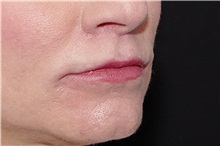 Lip Augmentation/Enhancement After Photo by Landon Pryor, MD, FACS; Rockford, IL - Case 38522