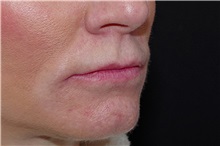 Lip Augmentation/Enhancement Before Photo by Landon Pryor, MD, FACS; Rockford, IL - Case 38522