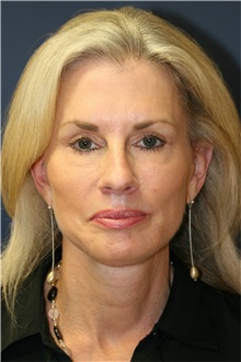 Facelift After Photo by Steve Laverson, MD, FACS; Rancho Santa Fe, CA - Case 38574