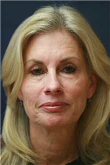 Facelift Before Photo by Steve Laverson, MD, FACS; Rancho Santa Fe, CA - Case 38574