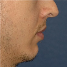 Chin Augmentation Before Photo by Scott Sattler, MD,  FACS; Seattle, WA - Case 38592