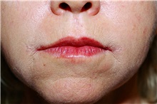 Lip Augmentation/Enhancement After Photo by Steve Laverson, MD, FACS; Rancho Santa Fe, CA - Case 38611