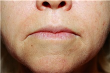 Lip Augmentation/Enhancement Before Photo by Steve Laverson, MD, FACS; Rancho Santa Fe, CA - Case 38611