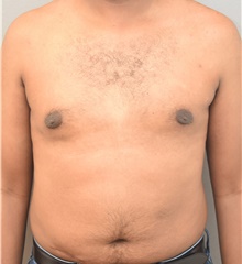 Male Breast Reduction After Photo by Keshav Magge, MD; Bethesda, MD - Case 38621