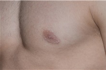 Male Breast Reduction After Photo by Landon Pryor, MD, FACS; Rockford, IL - Case 38810