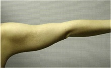 Arm Lift After Photo by Mariam Awada, MD, FACS; Southfield, MI - Case 38869