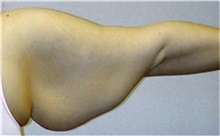 Arm Lift Before Photo by Mariam Awada, MD, FACS; Southfield, MI - Case 38869