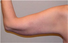 Arm Lift After Photo by Mariam Awada, MD, FACS; Southfield, MI - Case 38872