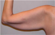 Arm Lift Before Photo by Mariam Awada, MD, FACS; Southfield, MI - Case 38872