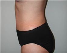 Body Lift After Photo by Mariam Awada, MD, FACS; Southfield, MI - Case 38874