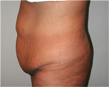 Body Lift Before Photo by Mariam Awada, MD, FACS; Southfield, MI - Case 38874