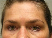 Brow Lift After Photo by Mariam Awada, MD, FACS; Southfield, MI - Case 38883