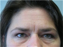 Brow Lift Before Photo by Mariam Awada, MD, FACS; Southfield, MI - Case 38883