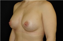 Breast Augmentation After Photo by Landon Pryor, MD, FACS; Rockford, IL - Case 38927