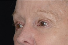 Eyelid Surgery After Photo by Landon Pryor, MD, FACS; Rockford, IL - Case 38987