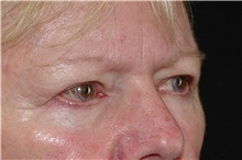 Eyelid Surgery Before Photo by Landon Pryor, MD, FACS; Rockford, IL - Case 38987