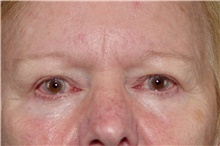 Eyelid Surgery Before Photo by Landon Pryor, MD, FACS; Rockford, IL - Case 38987