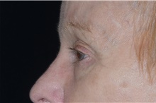 Eyelid Surgery After Photo by Landon Pryor, MD, FACS; Rockford, IL - Case 38987