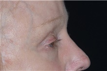 Eyelid Surgery After Photo by Landon Pryor, MD, FACS; Rockford, IL - Case 38987