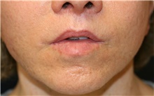 Lip Augmentation/Enhancement After Photo by Steve Laverson, MD, FACS; Rancho Santa Fe, CA - Case 39029