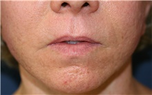 Lip Augmentation/Enhancement Before Photo by Steve Laverson, MD, FACS; Rancho Santa Fe, CA - Case 39029