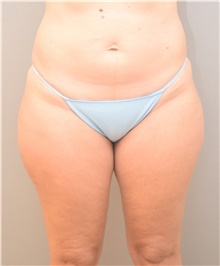 Liposuction Before Photo by Keshav Magge, MD; Bethesda, MD - Case 39495