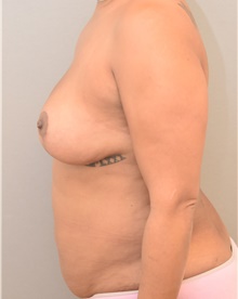 Breast Lift After Photo by Keshav Magge, MD; Bethesda, MD - Case 39558