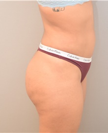 Buttock Lift with Augmentation After Photo by Keshav Magge, MD; Bethesda, MD - Case 39569