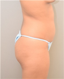 Buttock Lift with Augmentation Before Photo by Keshav Magge, MD; Bethesda, MD - Case 39569