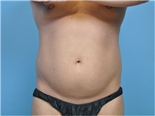 Body Contouring Before Photo by John Connors, III, MD; Alpharetta, GA - Case 39705