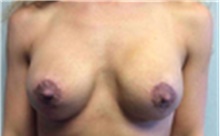 Breast Implant Removal After Photo by Mariam Awada, MD, FACS; Southfield, MI - Case 40149