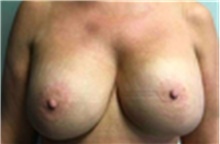 Breast Implant Removal After Photo by Mariam Awada, MD, FACS; Southfield, MI - Case 40150